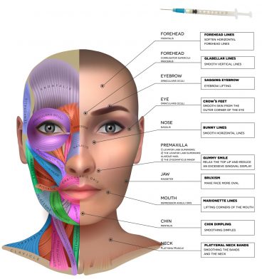 The diagram illustrates which areas and the specific muscles where Botox is effective. It also lists the desired effect of each injected area. The diagram only lists the cosmetic uses of Botox and not the theraputic.