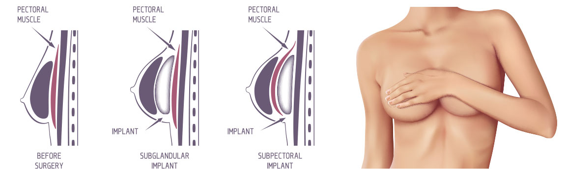 The image above illustrates the 2 common placements of the breast implant for breast augmentation surgery. Subglandular or subpectoral. Note how the implant appears either above or below the pectoral muscle. 