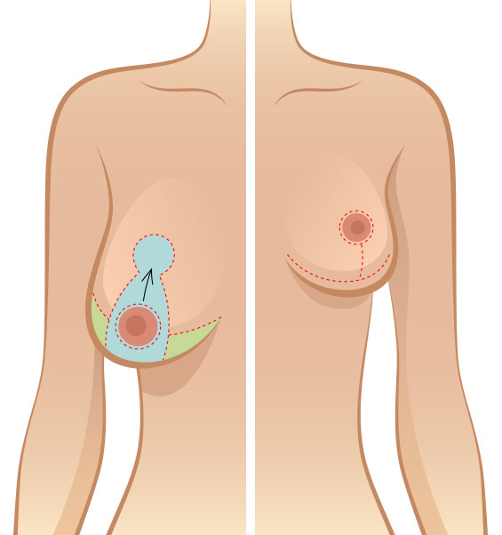 Breast lift surgical diagram illustrating the different types of incisions used to raise and lift the breasts.