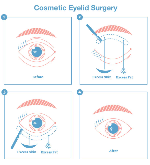 The illustration is a very simplified depiction of the more common, stripped down, basic components of blepharoplasty surgery. The diagram shows the removal of excess skin and surplus fat from the upper and lower lids. It should be noted that very few real-world cases actually match the diagram. Every blepharoplasty surgery is different as a result of the fact that every patient is different in their needs and their anatomy. 