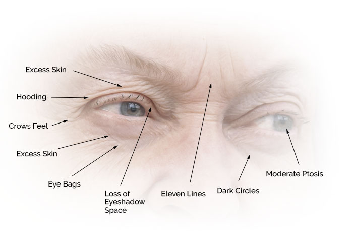 The diagram points out specific conditions attributed to aging around the eyes. A severely aged example was used to more easily show clear examples of these conditions.