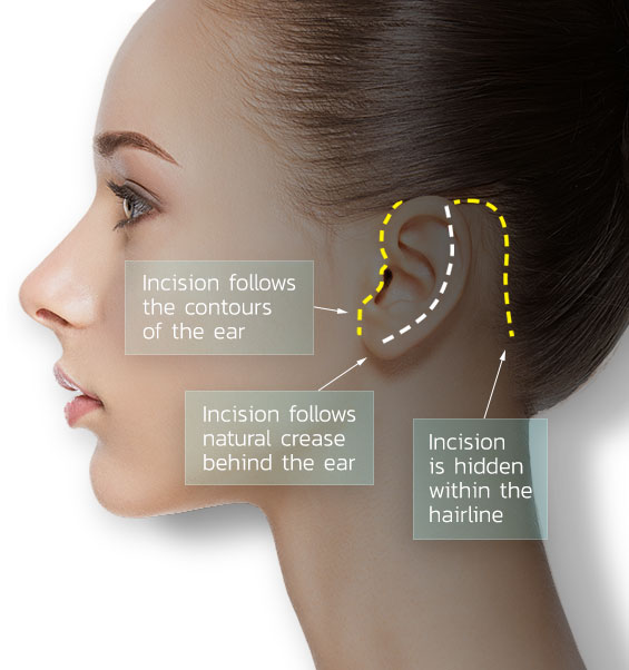 The diagram shows the most common incisions used for the various facelift surgeries performed by Dr. Pasquale. The incisions are shorter and less conspicuous than many of your typical, traditional facelift incisions which may be more visible or invasive.